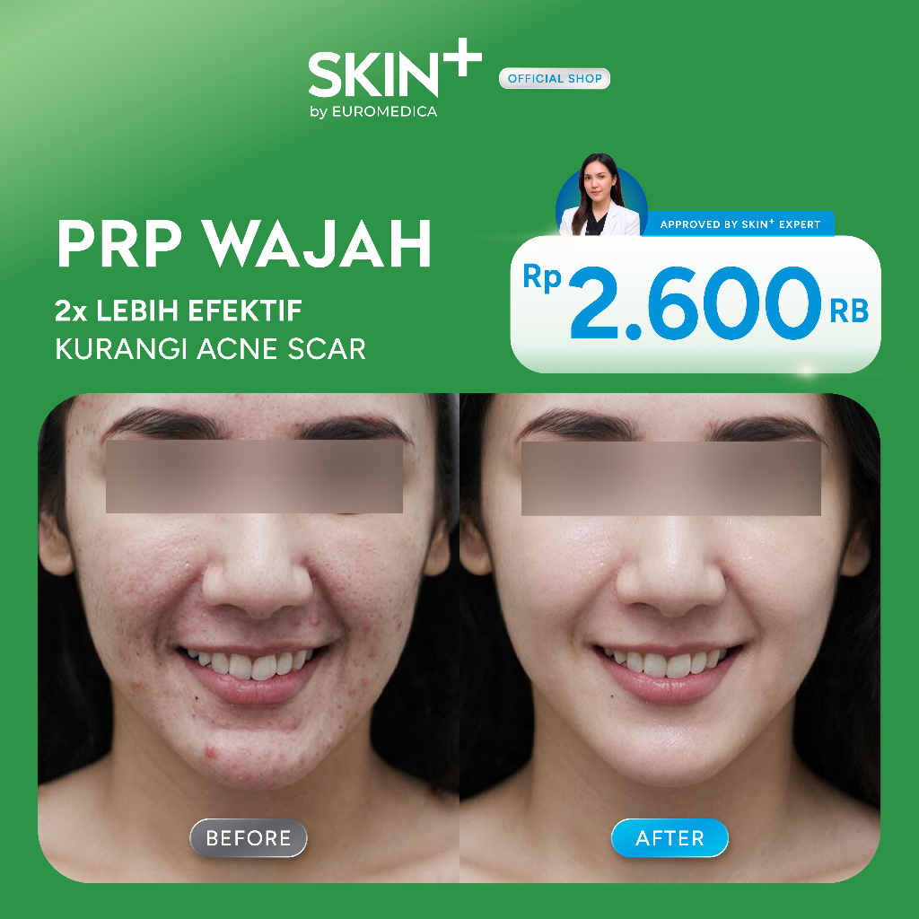 SKIN+ Clinic PRP Wajah Treatment - Regenerasi Kulit & Glow Alami