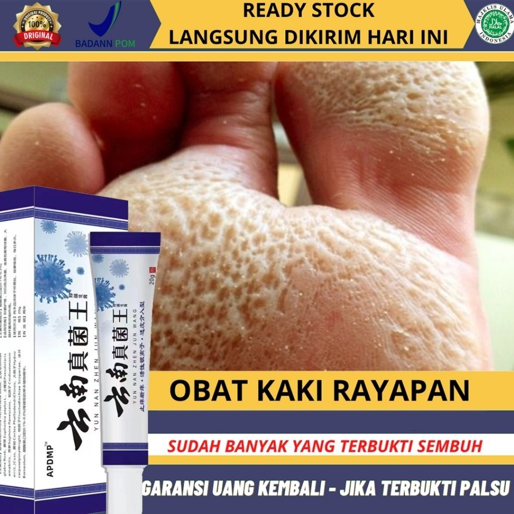 YUNNAN Obat Kaki Rayapan Dan Bau Salep Yunnan Obat Gatal Krim Pengelupas Kulit Mati Kaki Pembersih O
