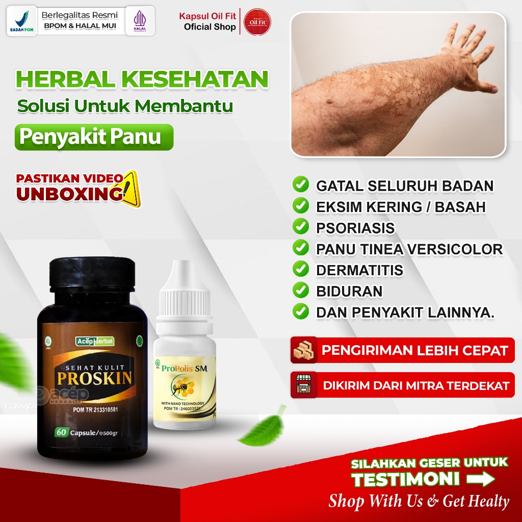 Obat Panu Psoriasis Gatal Kulit Kepala Kurap Gatal Selangkangan Anak dan Dewasa Eksim Jamur gatal Ga