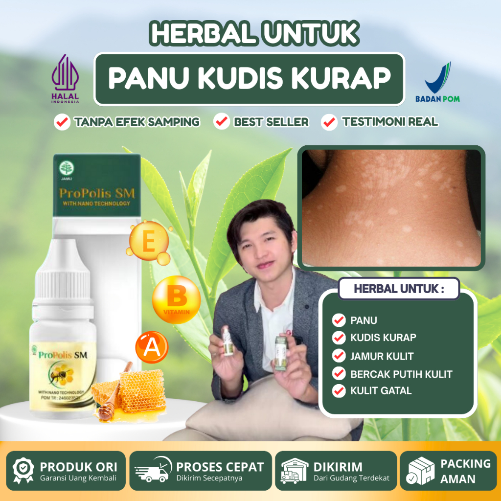 Obat Panu Kudis Kurap, Bercak putih di kulit wajah punggung, Penghilang Jamur Kulit Panu