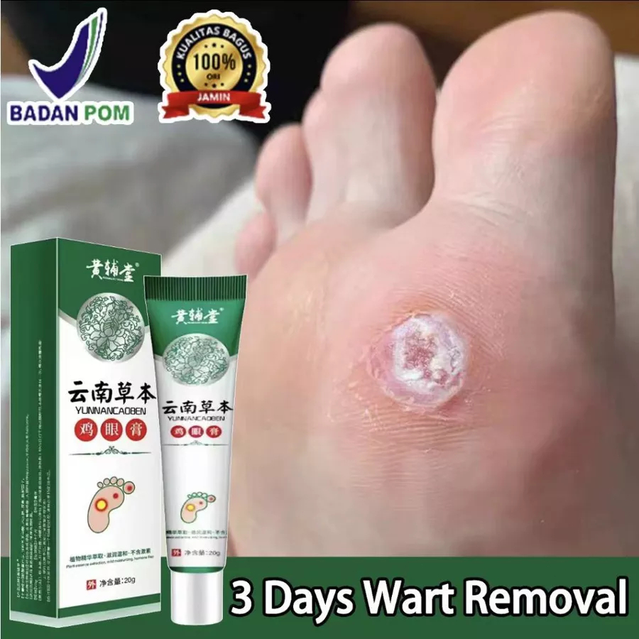 Obat Mata Ikan Obat Kutil Kapalan Mata Ikan Kaki 20gr Kaki Ampuh Plester Penghilang Kutil Kapalan Ma