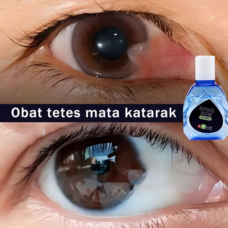Obat tetes mata obat mata katarak obat tetes mata katarak tetes mata minus paling ampuh 10ml Tetes m