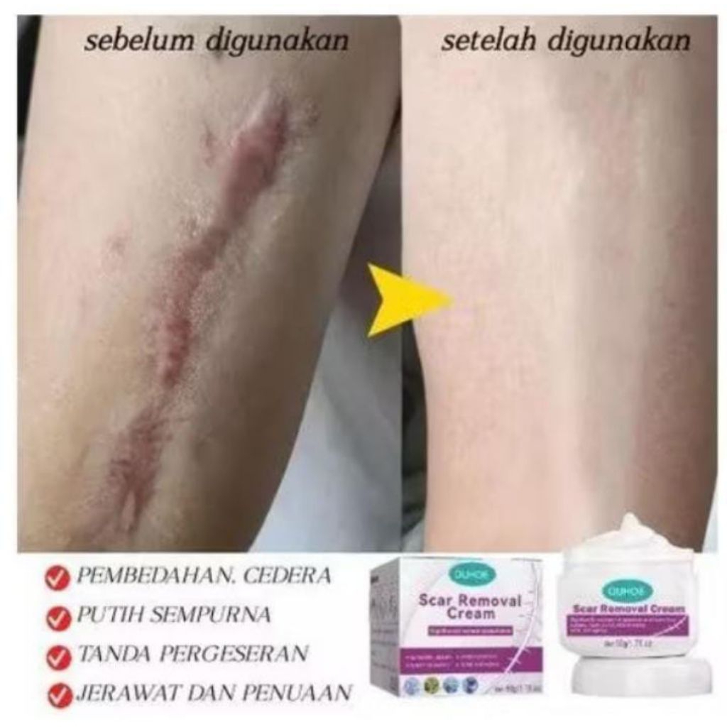Obat Penghilang Bekas Luka Salep Bekas Luka Krim Scar Removal Krim Cream hilangkan menghilangkan bek