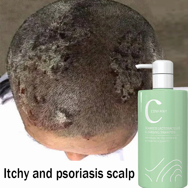 Shampo anti ketombe Shampo psoriasis Anti gatal shampo Shampo Anti Ketombe Oil control Shampo anti k