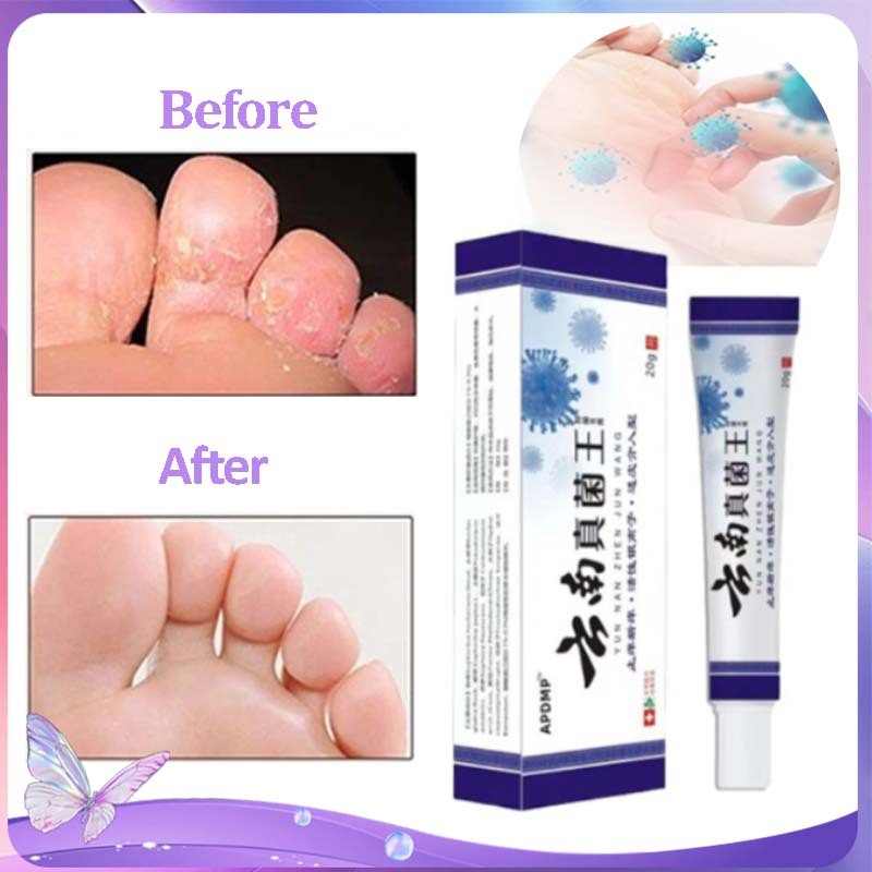 Obt Kaki Rayapan Dan Bau Salep Kaki Rayapan Dan Bau Obat Kaki Bau Krim Antibakteri Tinea Pedis Jamur