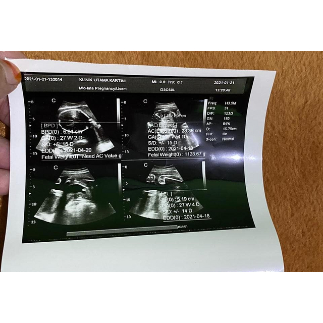 USG 2 Dimensi dengan dokter SpOG