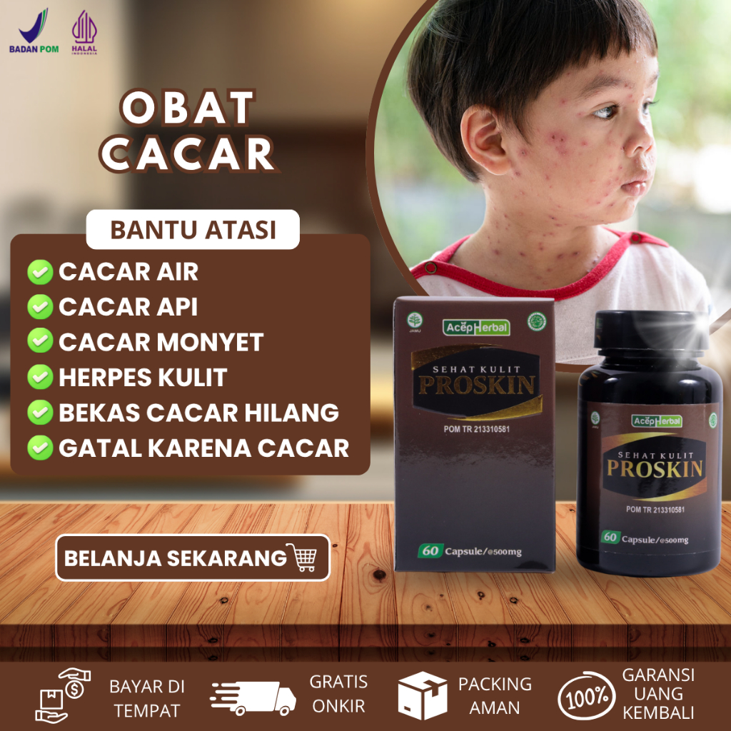 Obat Cacar Air, Obat Cacar Api, Obat Penghilang Bekas Cacar, Obat Cacar Monyet Obat Cacar Bintik Bin