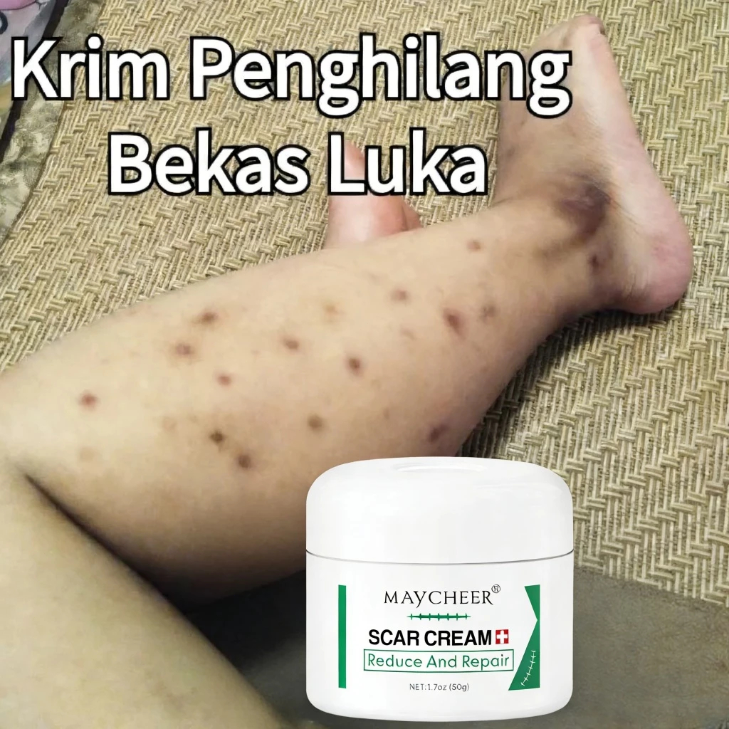 Bekas luka hitam di kaki Penghilang bekas luka hitam koreng Menghilangkan bekas luka menghitam 50g M