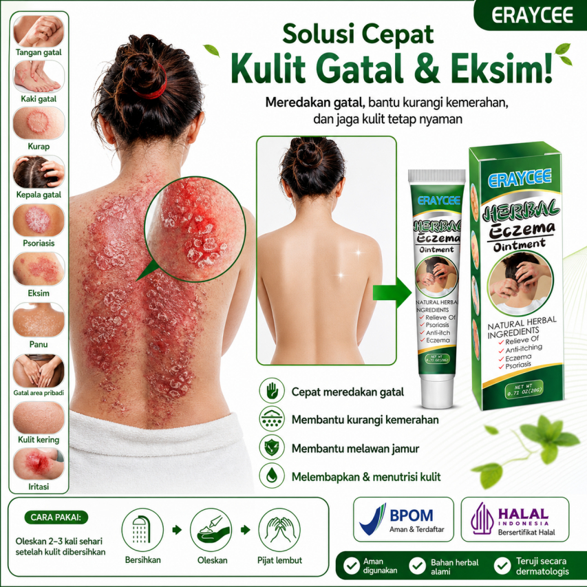 Salep untuk gatal-gatal pada kulit, ampuh mengobati kurap pada tangan dan kaki, kurap selangkangan, 