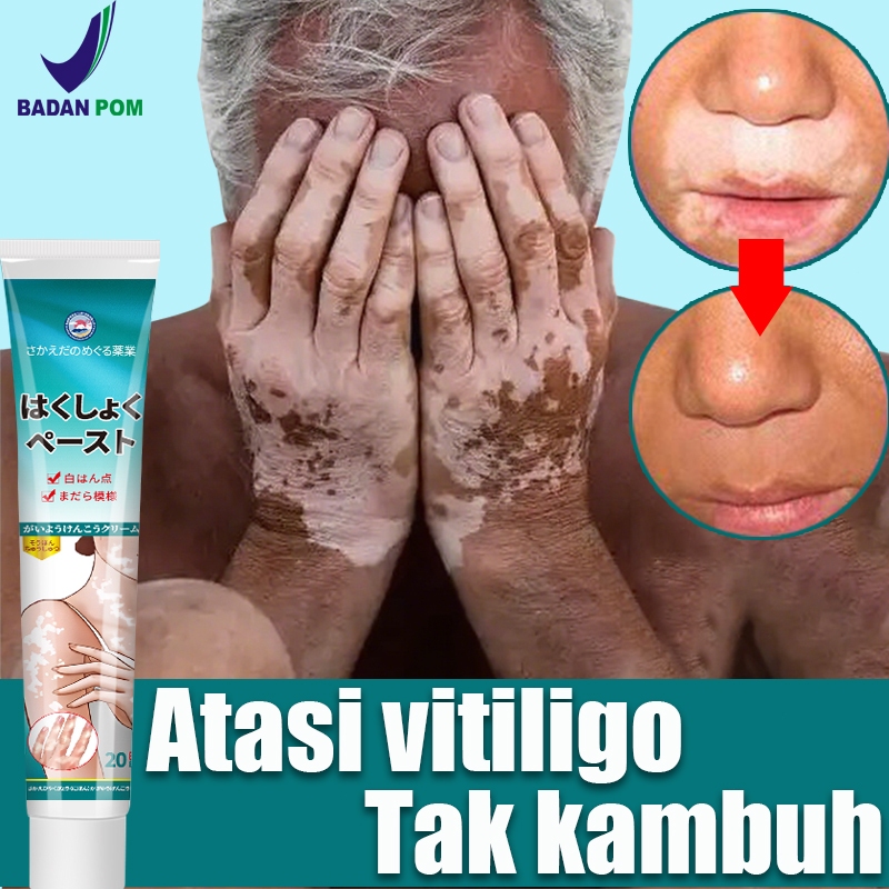 Krim vitiligo/salep vitiligo /Obat Vitiligo/ Salep bintik putih khusus vitiligo Untuk Kulit Bercak P