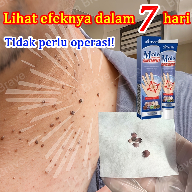 penghilang kutil dan tahi lalat  obat kutil ampuh  obat penghilang kutil penghilang tahi lalat di wa