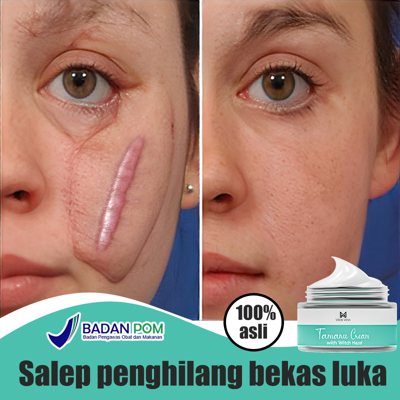 Salep keloid paling ampuh salep penghilang bekas luka penghilang bekas luka hitam koreng cream pengh