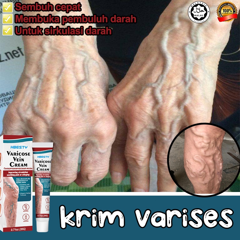 Varises original obat parises kaki paling ampuh salep varises 30g salep laba-laba Pengobatan Vaskuli