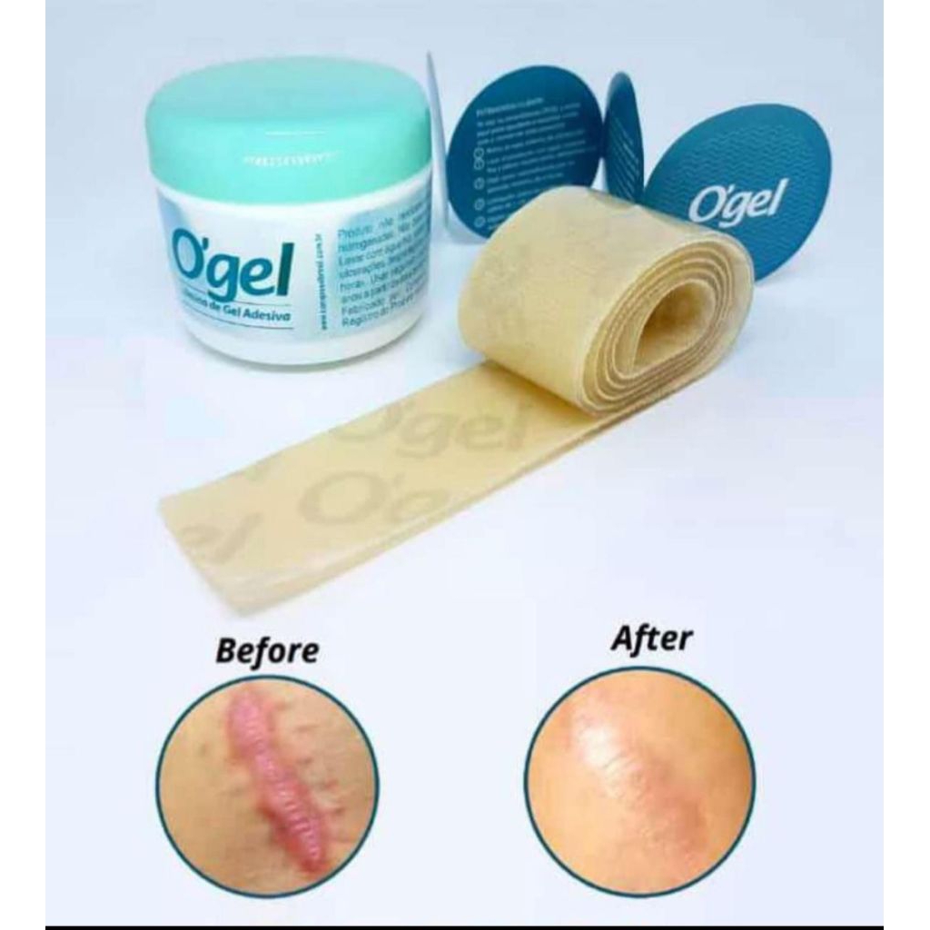 plester pencegah keloid/scar