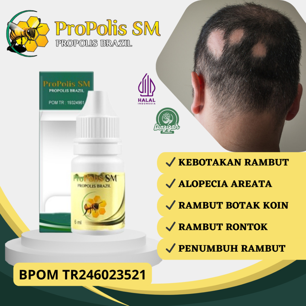 Obat Penumbuh Rambut Pitak, Obat Alopecia Areata, Obat Botak Koin, Obat Kerontokan Rambut, Obat Ramb