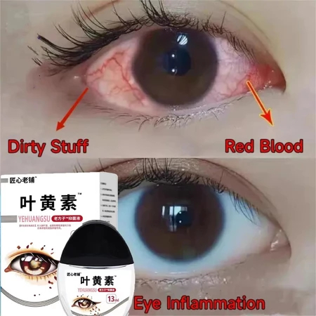 Tetes mata tetes mata katarak mata kering mata perih kemerahan mata lelah miopia katarak berlemak pe