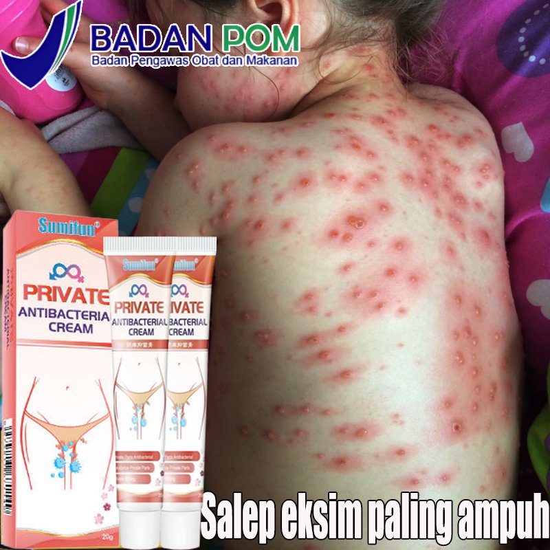 Private parts Antibacteria anti-itching cream salap gatal kulit yang ampuh - obat gatal selangkangan