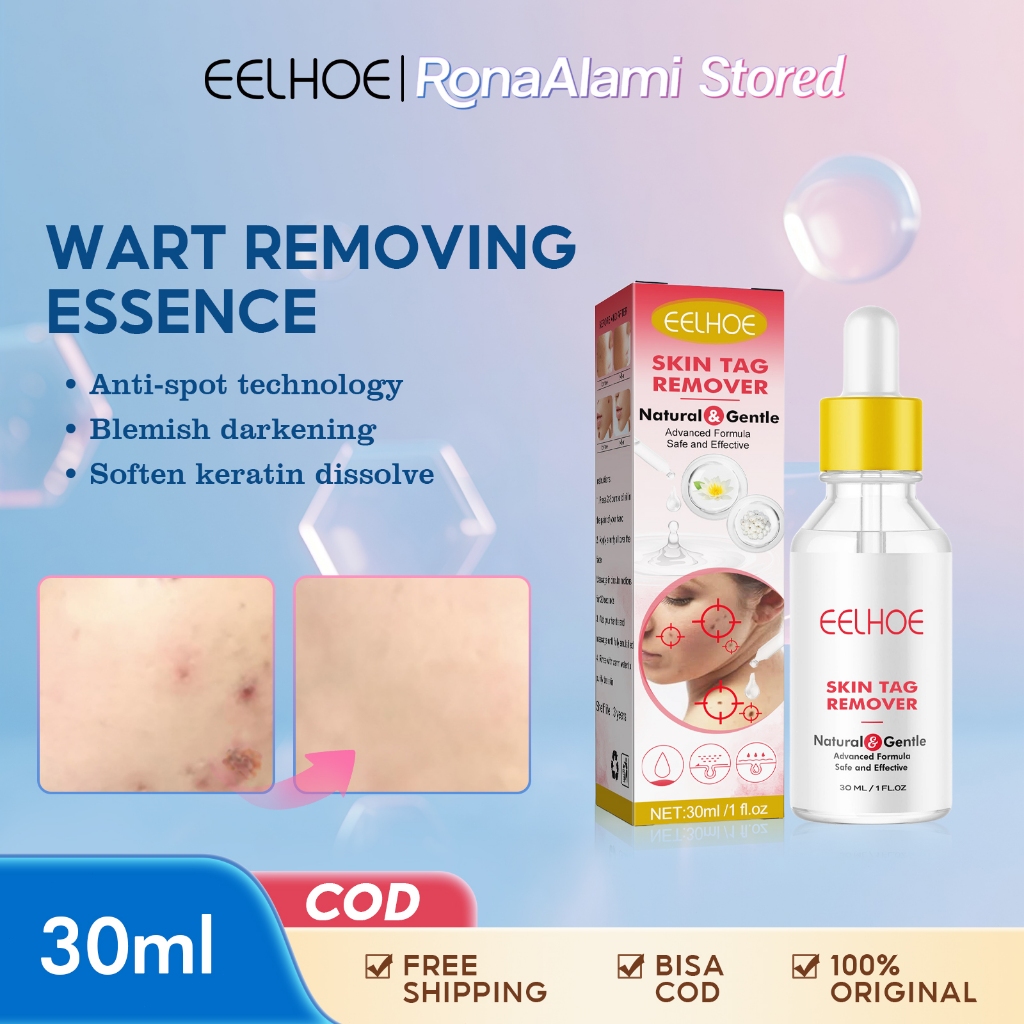 EELHOE 30ml Esensi Esensi Penghilang Kutil Penghilang Tahi Lalat Perbaikan Kulit Kulit Datar Penghil