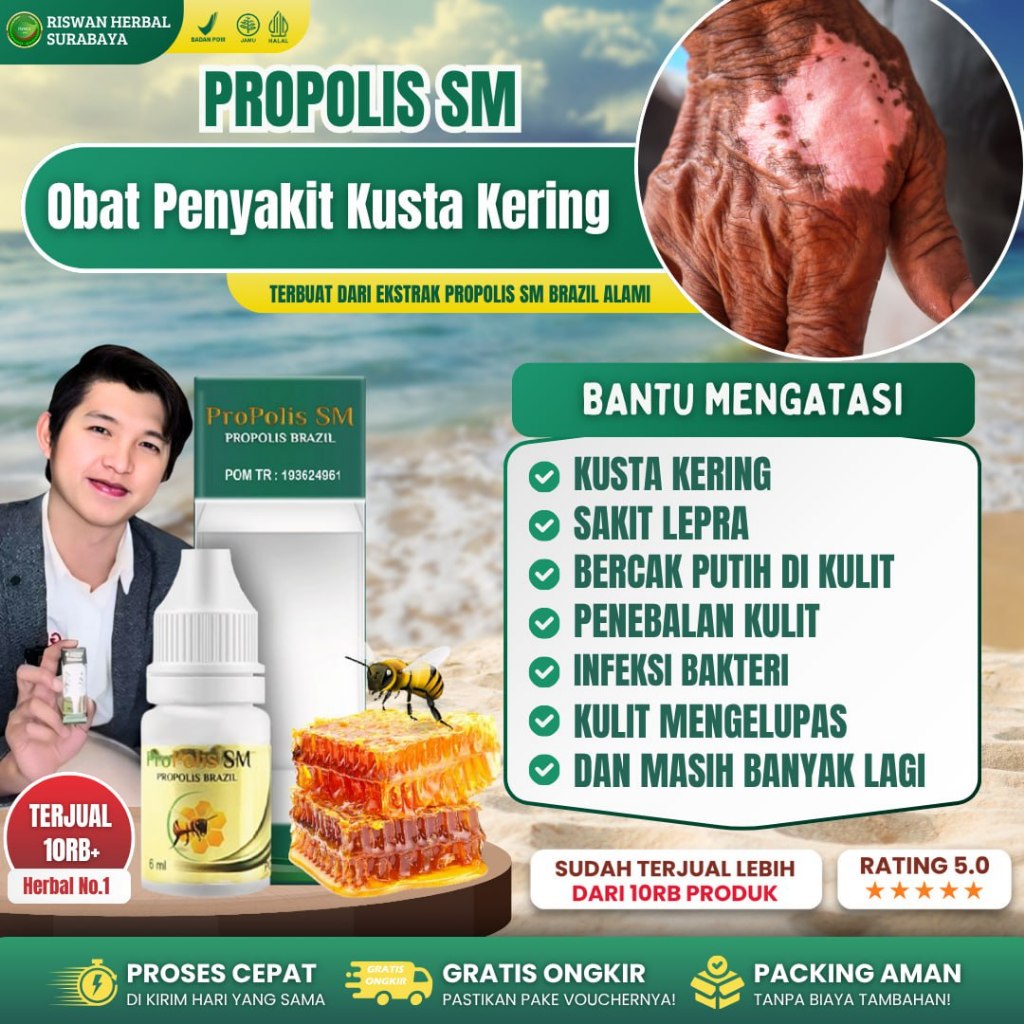 Obat Penyakit Kusta Kering Dan Basah Gatal Kulit Ruam Di Tangan Bintik Bintik Propolis Sm