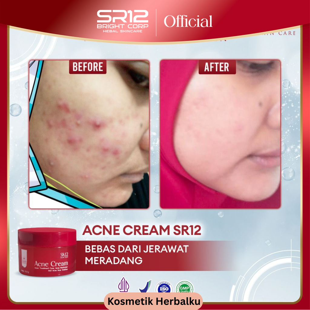 SR12 Acne Series Cream Totol Paket Skincare Sabun Krim Kulit Jerawat Batu Meradang