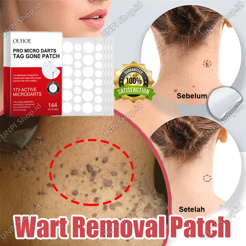 Sticker Penghilang Kutil Dan Tahi Lalat Obat Kutil Di Wajah Penghilang Kutil Di Leher Wart Remover P