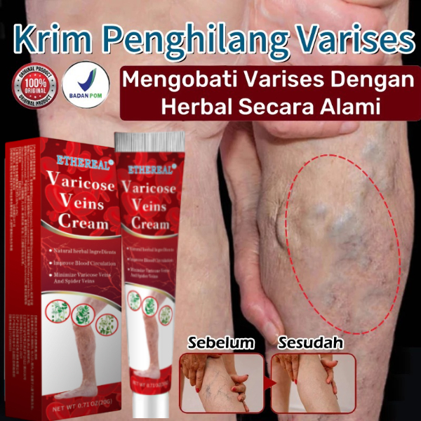 Salep Varises Efektif Untuk Kaki Dan Betis Obat Varises Varicose Veins Cream Penghilang Varises, Oba