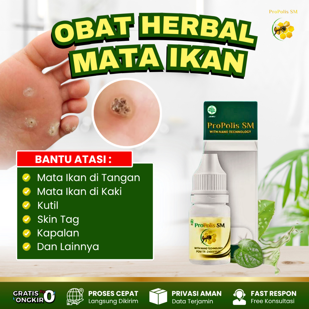Obat Mata Ikan Telapak kaki - Obat Mata Kaki Hitam - Obat Mata Kaki Bengkak Kering Hitam - Obat Kaki