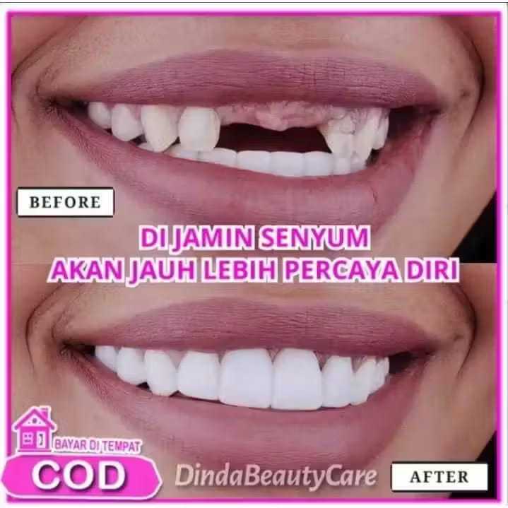 Smailine - Gigi Palsu Atas Bawah Sepasang Di Bentuk Instant