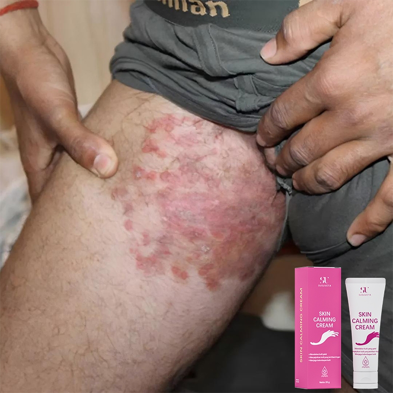 Salap gatal china salep eksim kering dan gatal salep china gatal paling ampuh 20g obt selangkangan h