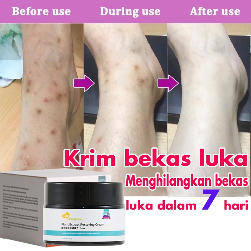 Krim Penghilang Bekas Luka Obat Penghilang Bekas Luka Bekas Luka Jahitan Gigitan Serangga Bekas Luka