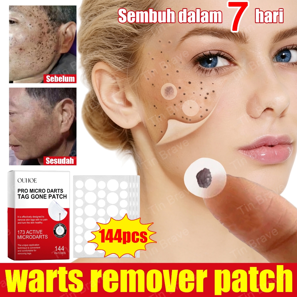 penghilang tahi lalat di wajah penghilang kutil dan tahi lalat wart removal original skin tag patche