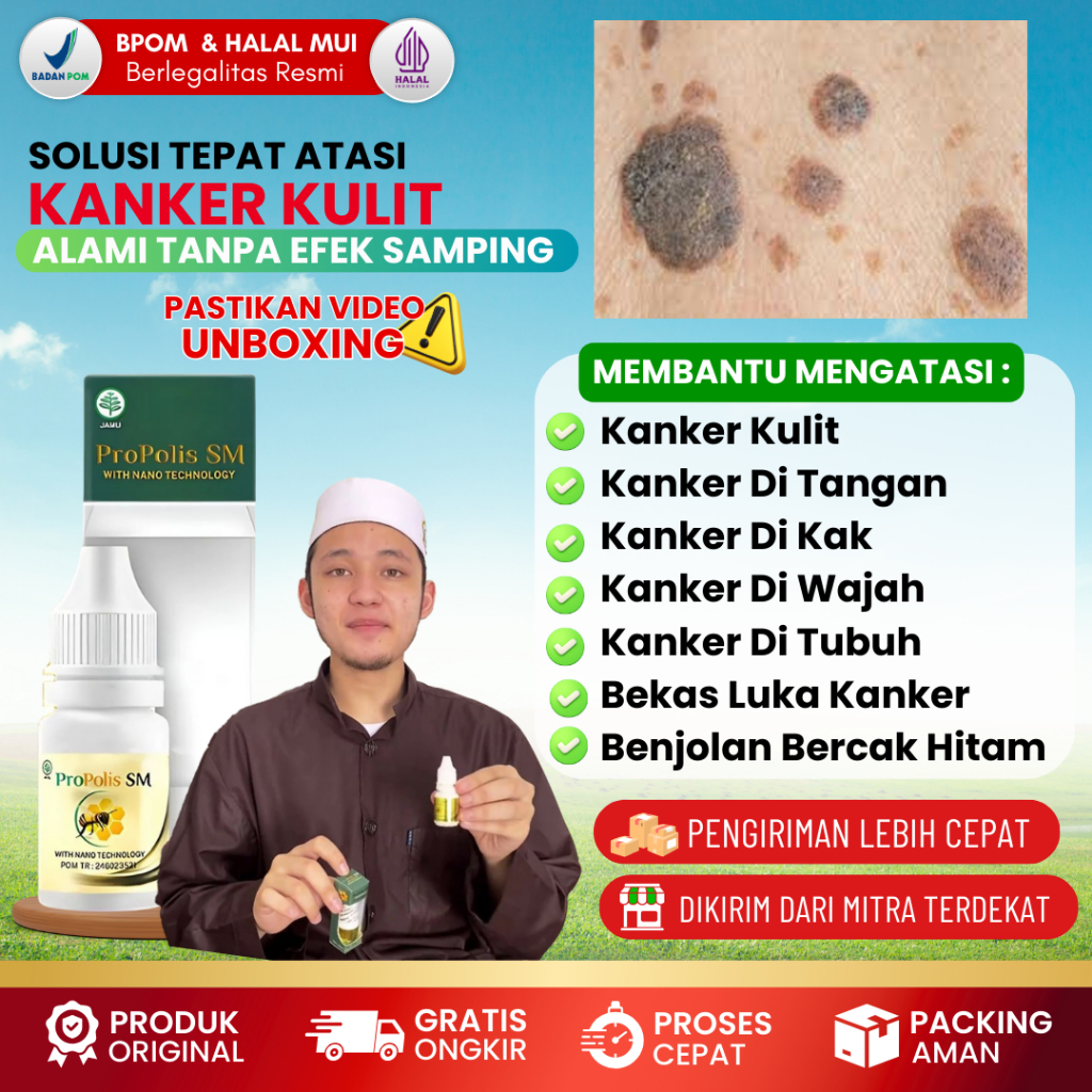 Obat Kanker Kulit, Obat Kanker Melanoma, Obat Kanker Kulit Di Wajah Tangan Dan Kaki, Obat Oles Kanke