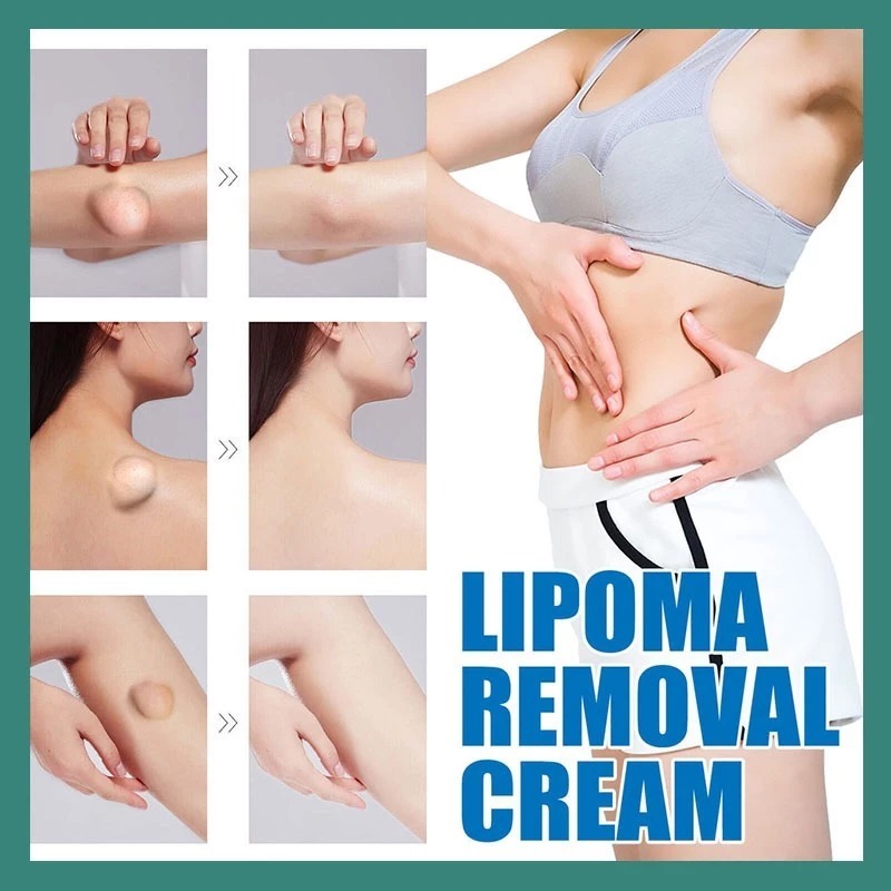 COD - Lipoma removal cream original  Obat benjolan Lipoma cream original 20g salep benjolan lipoma l