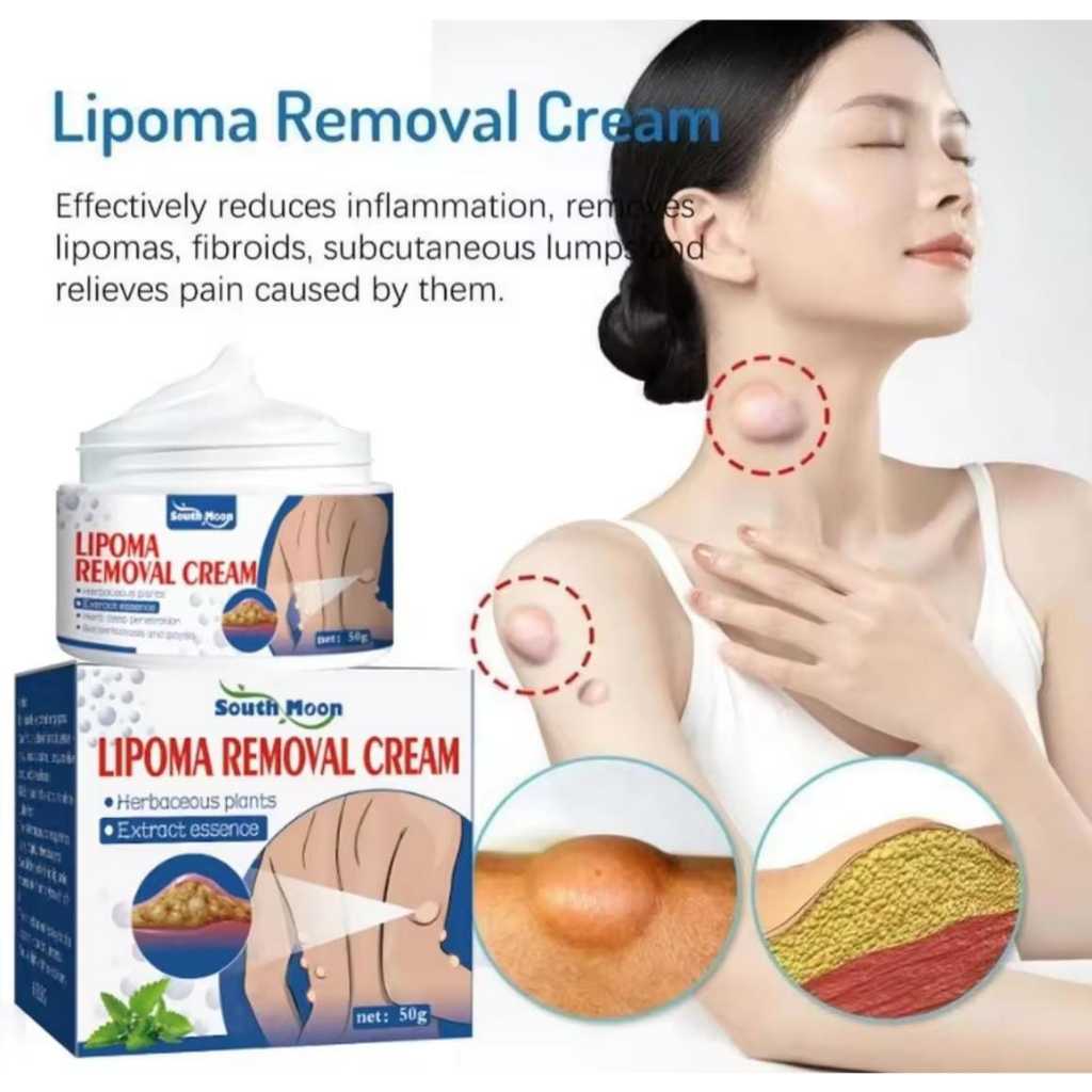 Lipoma Removal Cream 50g Herbal Cina Krim Salep Benjolan Lipoma Salep Lipoma Perawatan Punggung Lehe