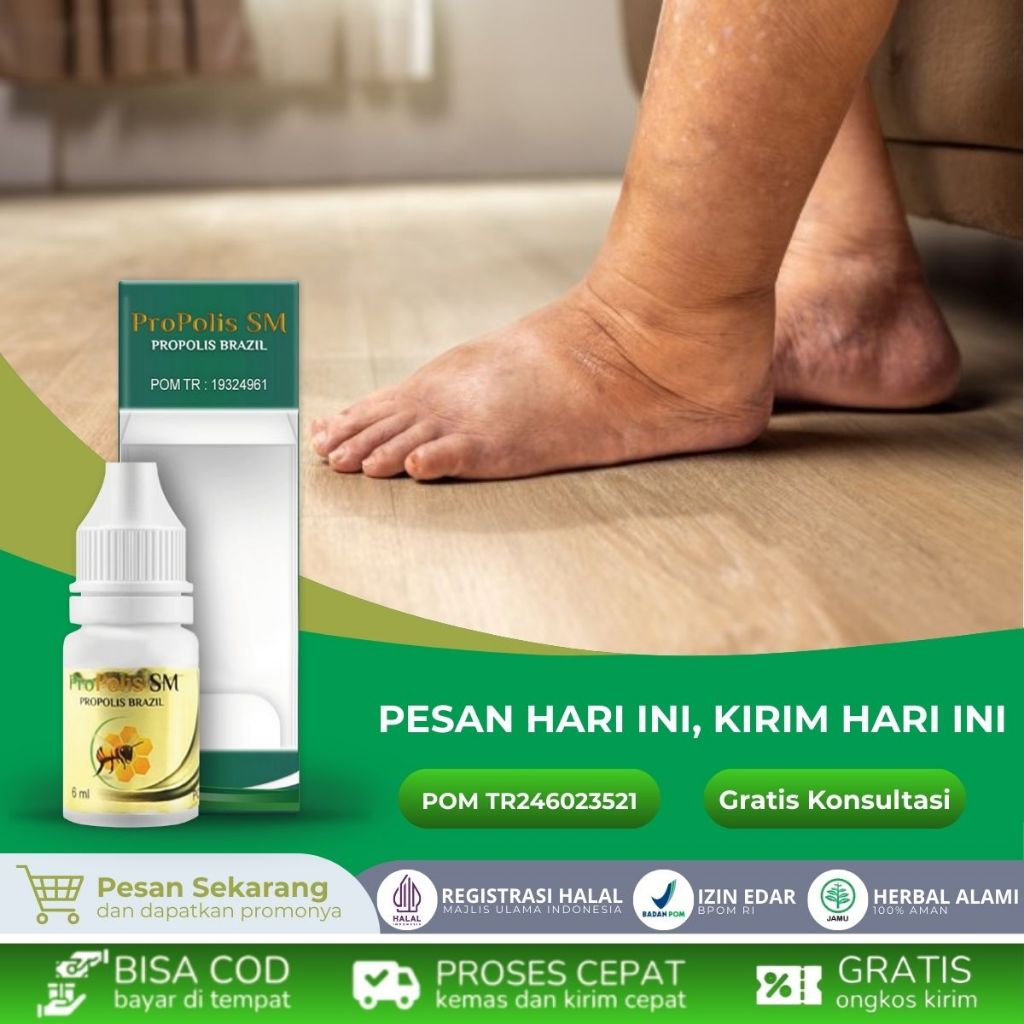 Obat Kaki Bengkak, Obat Bengkak Pada Kaki, Obat Kaki Bengkak & Nyeri, obat Kaki bengkak diabetes, Ob