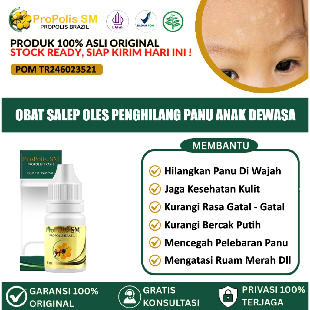 Obat Panu Anak, Di Wajah Anak, Obat oles Penghilang Panu Untuk Anak, obat panu   anak untuk di wajah