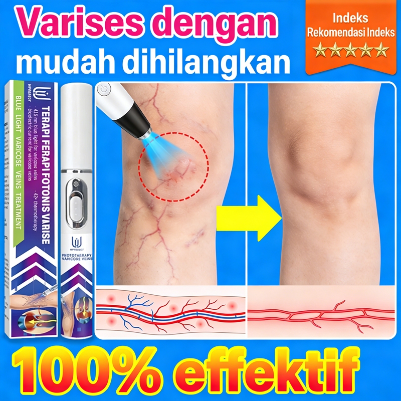 Pena Terapi Laser untuk Varises: Mengurangi Nyeri, Kelelahan, Pembengkakan, Mati Rasa, dan Kejang