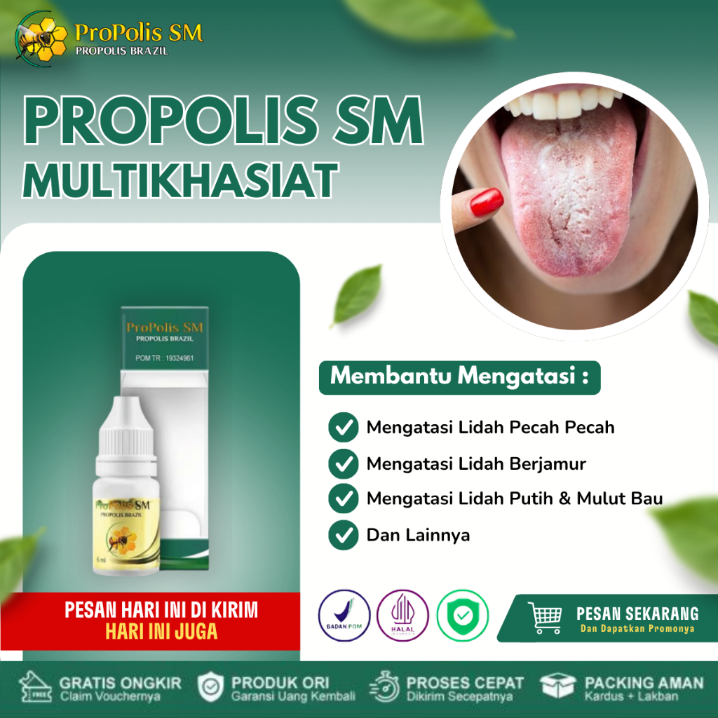 Obat Lidah Pecah Pecah, Obat Iritasi Lidah, Obat Lidah Berjamur, Obat Pembengkakan Lidah, Obat Lidah
