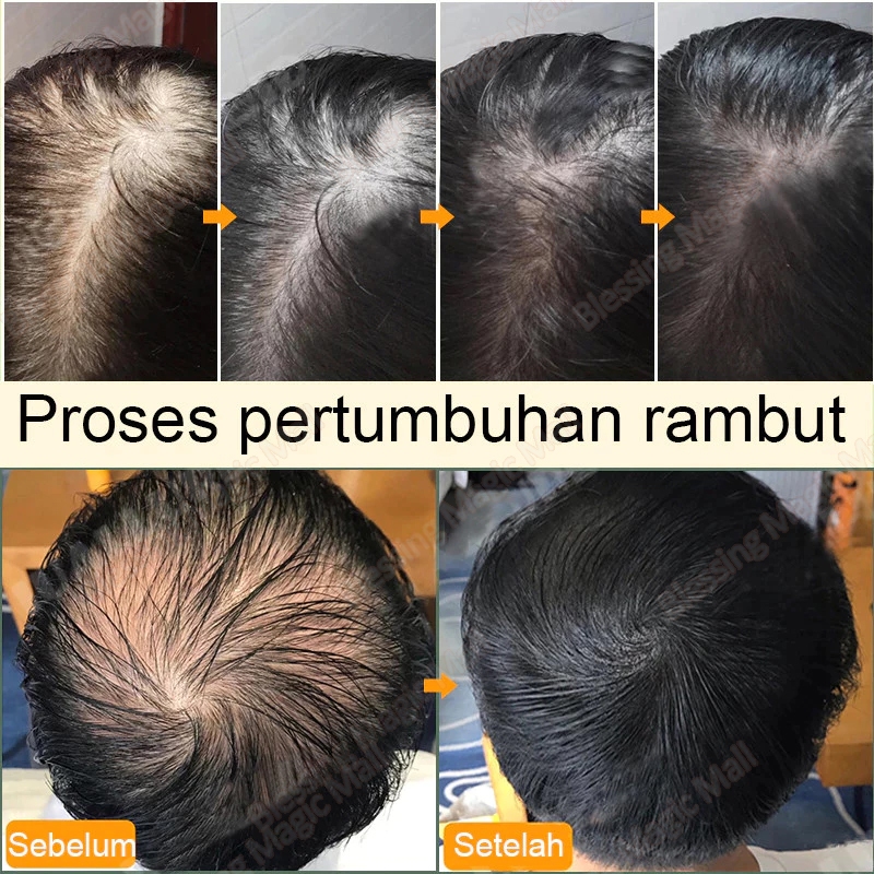 Penumbuh Rambut Cepat Dan Tebal Serum Rambut Roller Rosemary Oil Obat Rambut Rontok Serum Rambut