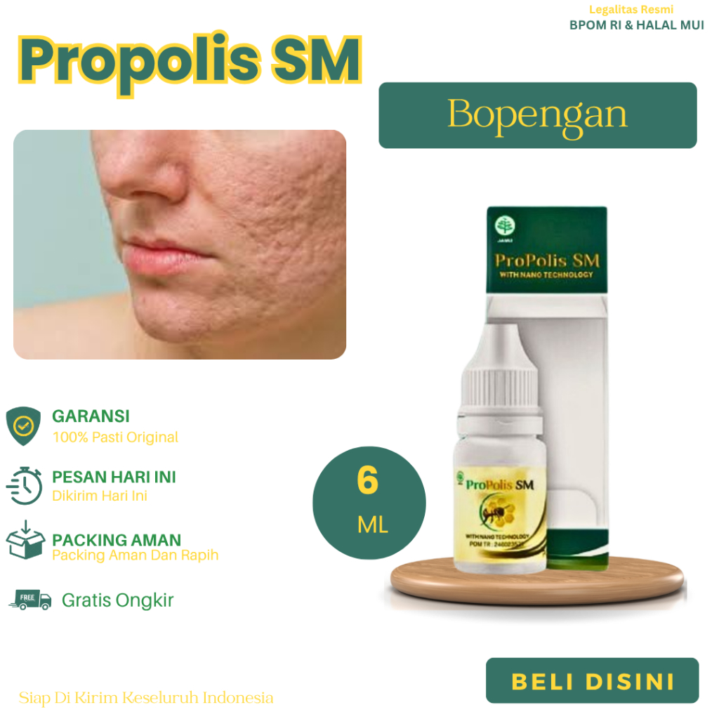 Obat Penghilang Bopeng, Bopeng Membandel, Bopeng Bekas Jerawat, Bopeng Berlubang, Menghilangkan Bope