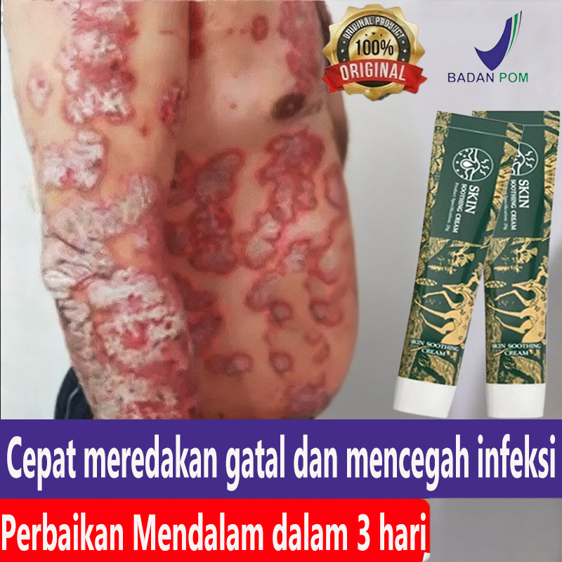 obat kurap salep china gatal paling ampuh salep gatal selangkangan salap gatal kulit yang ampuh  oba