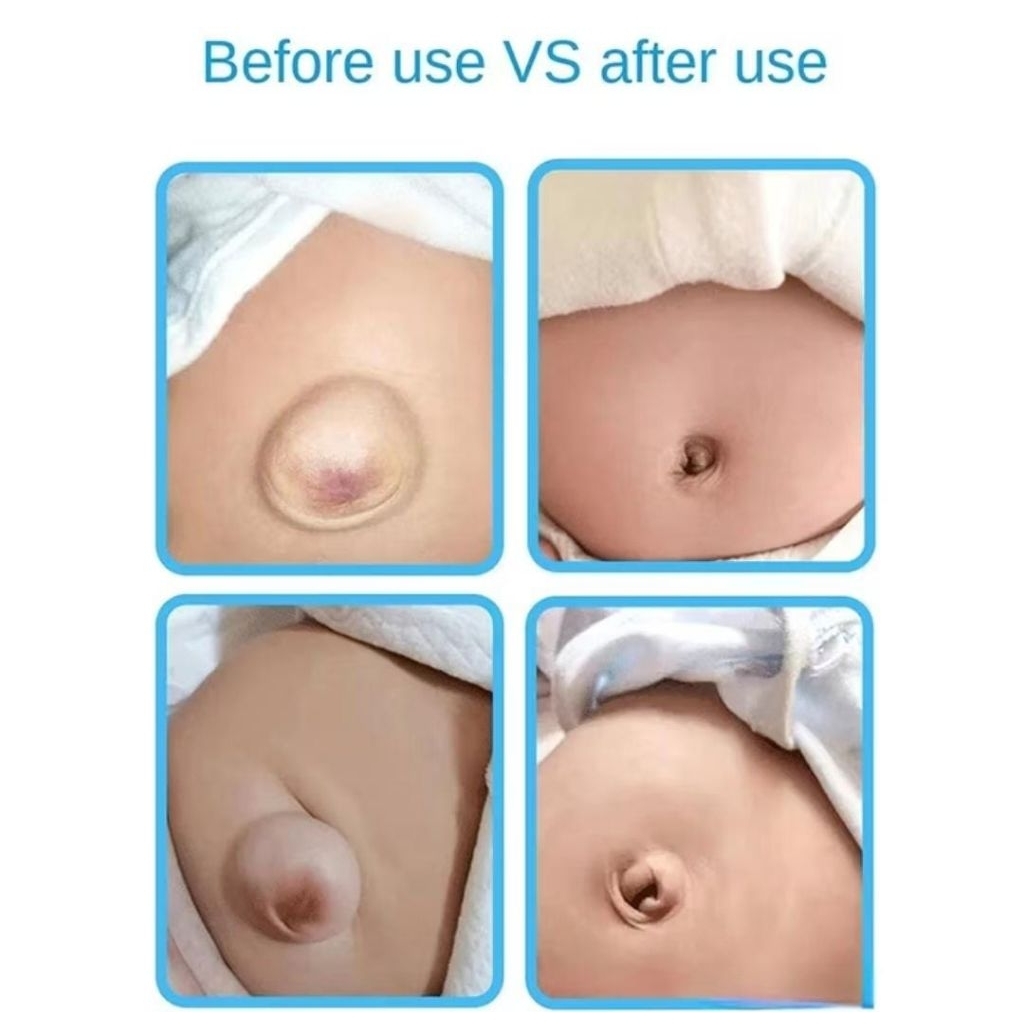 STIKER HERNIA / STIKER PUSAR BODONG / SABUK HERNIA HONS / PUSAR BODONG BAYI