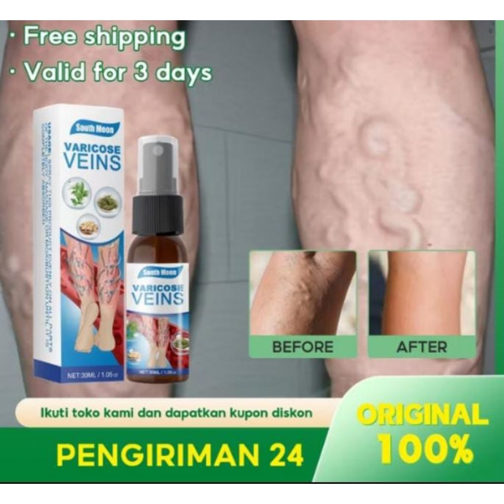 Obat Varises Salep Cream Oles Varicose Veins Spray Original Treatment Spray Ampun Aman Efektif Spide