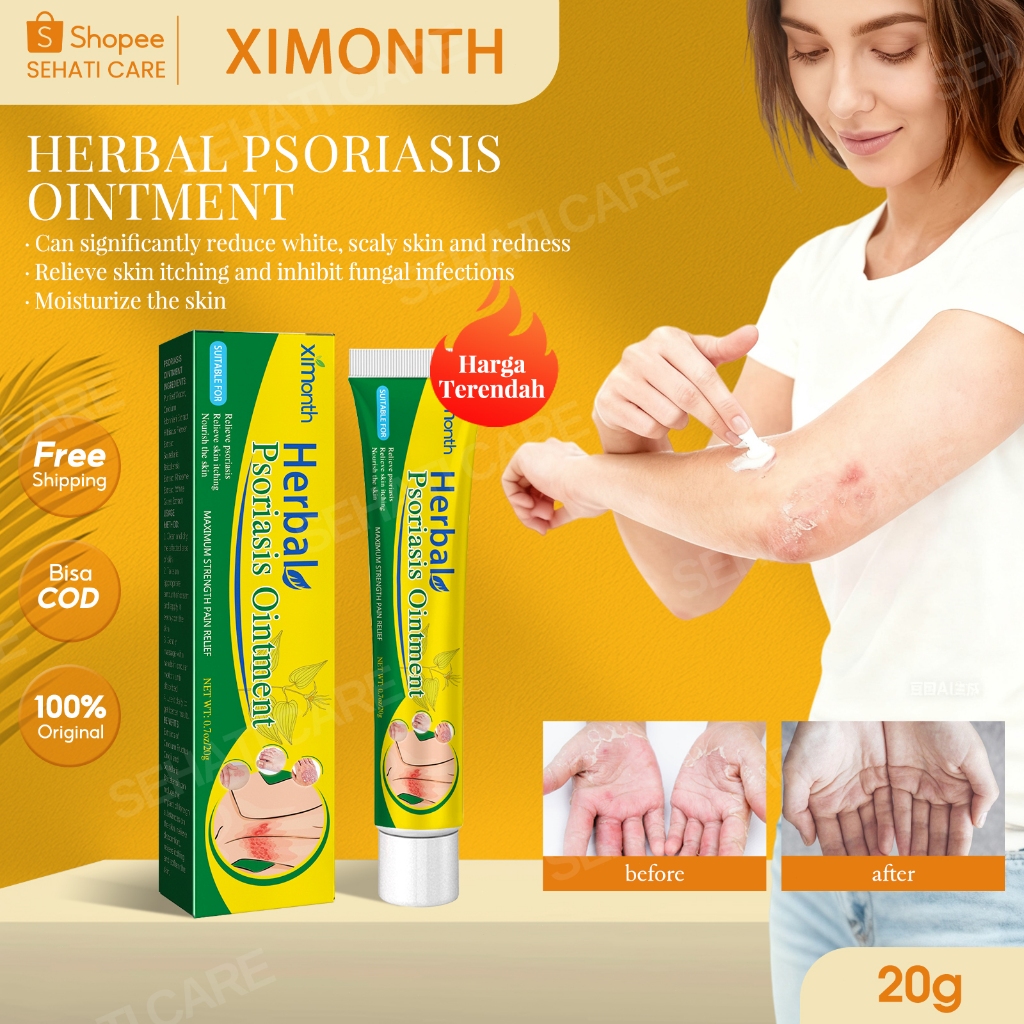 Ximonth Herbal Psoriasis Ointment 20g Krim Psoriasis Penghilang Gatal Cepat Kemerahan Gatal-Gatal Me
