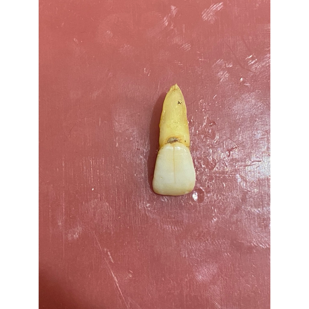 Gigi insisivus rahang atas (gigi 21)