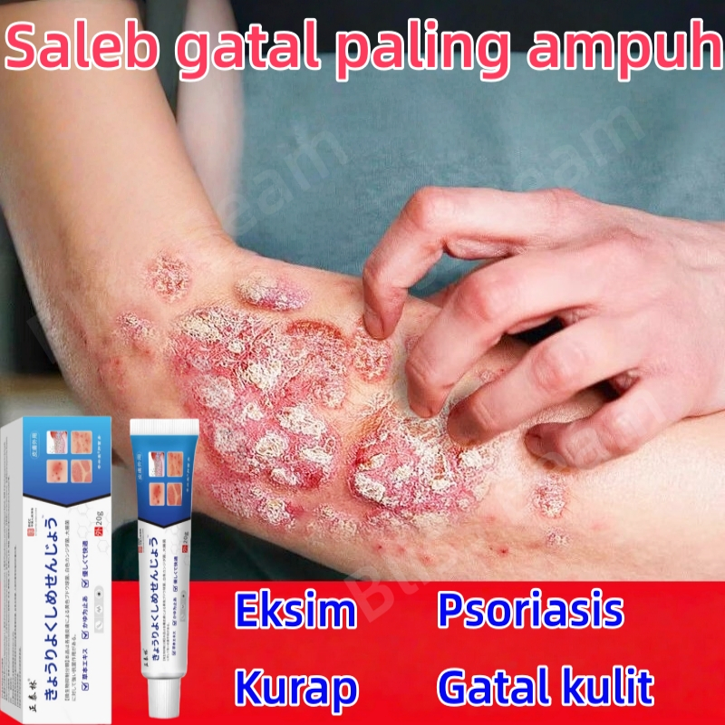 Salep eksim Saleb gatal paling ampuh Menghilangkan Kurap Psoriasis Infeksi Jamur dan Gatal di Selang