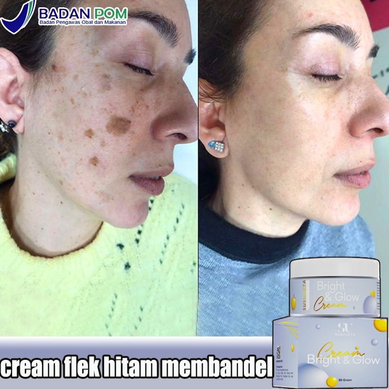 Salep flek hitam membandel Cream flek hitam membandel Menghilangkan flek hitam di wajah krim penghil
