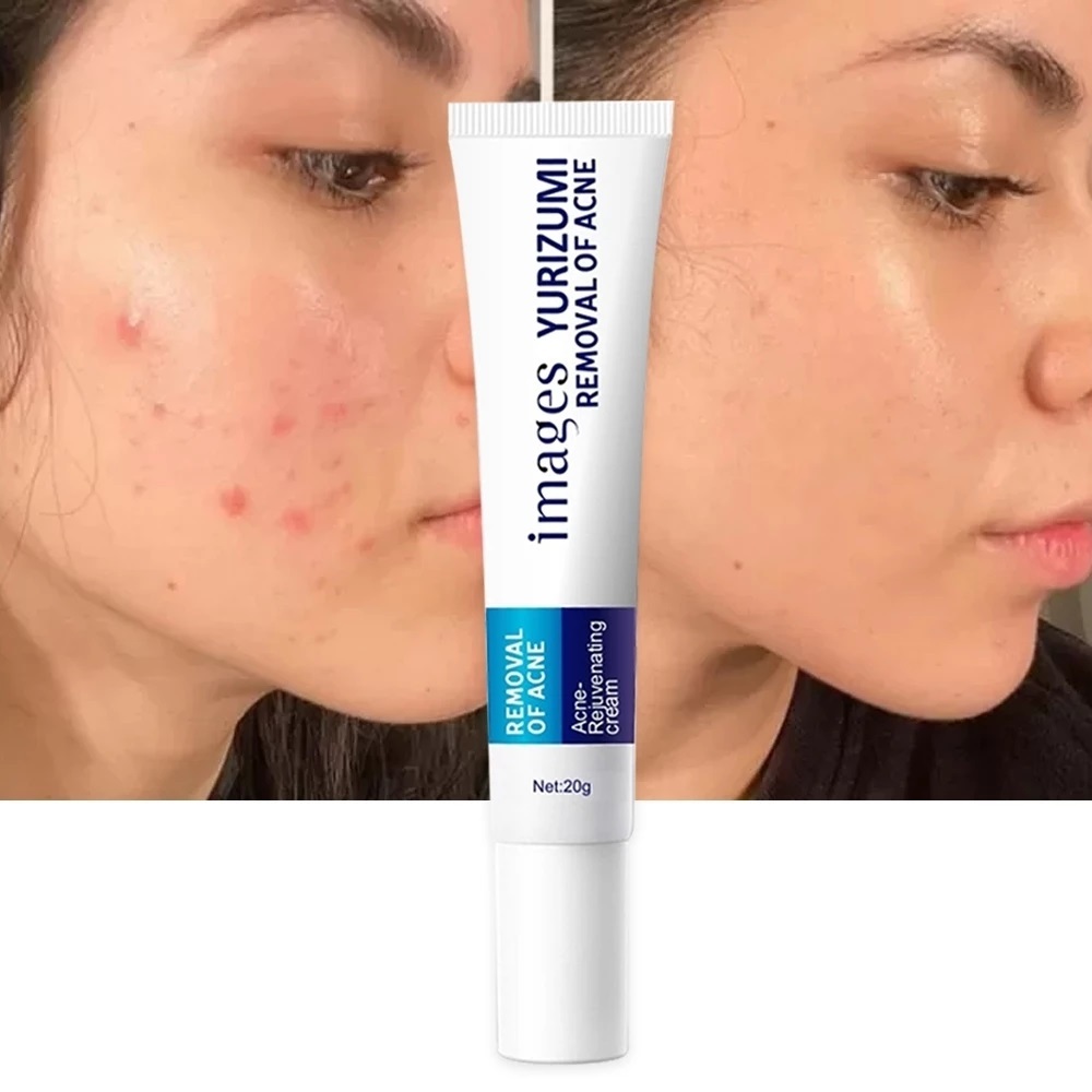 Images Yurizumi Removal Of Acne Cream Menghilangkan Jerawat & Bekas Jerawat