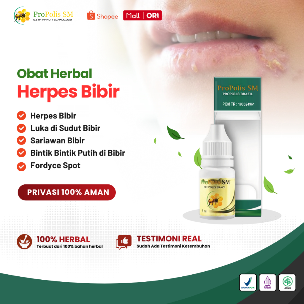 Obat Herpes Bibir, Luka Di Sudut Bibir, Sariawan Bibir, Fordyce Spots Bintik Putih di Bibir, Bercak 