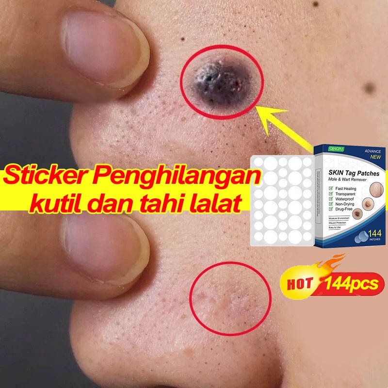 Stiker Penghilang Kutil Dan Tahi Lalat Skin Tag Remover Wart Remover Patch Patch Penghilang Kutil Pe